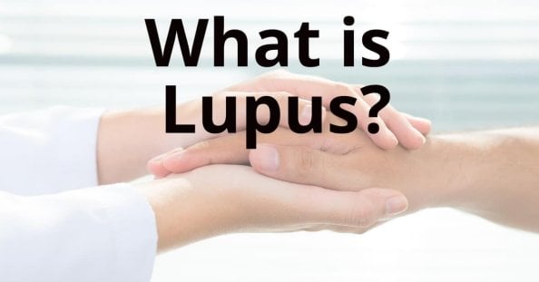 lupus treatment