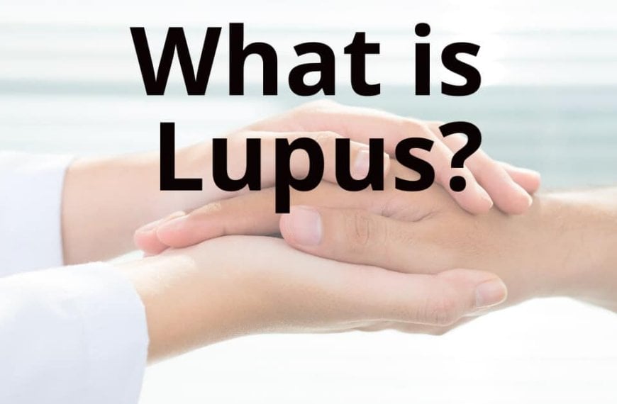 lupus treatment