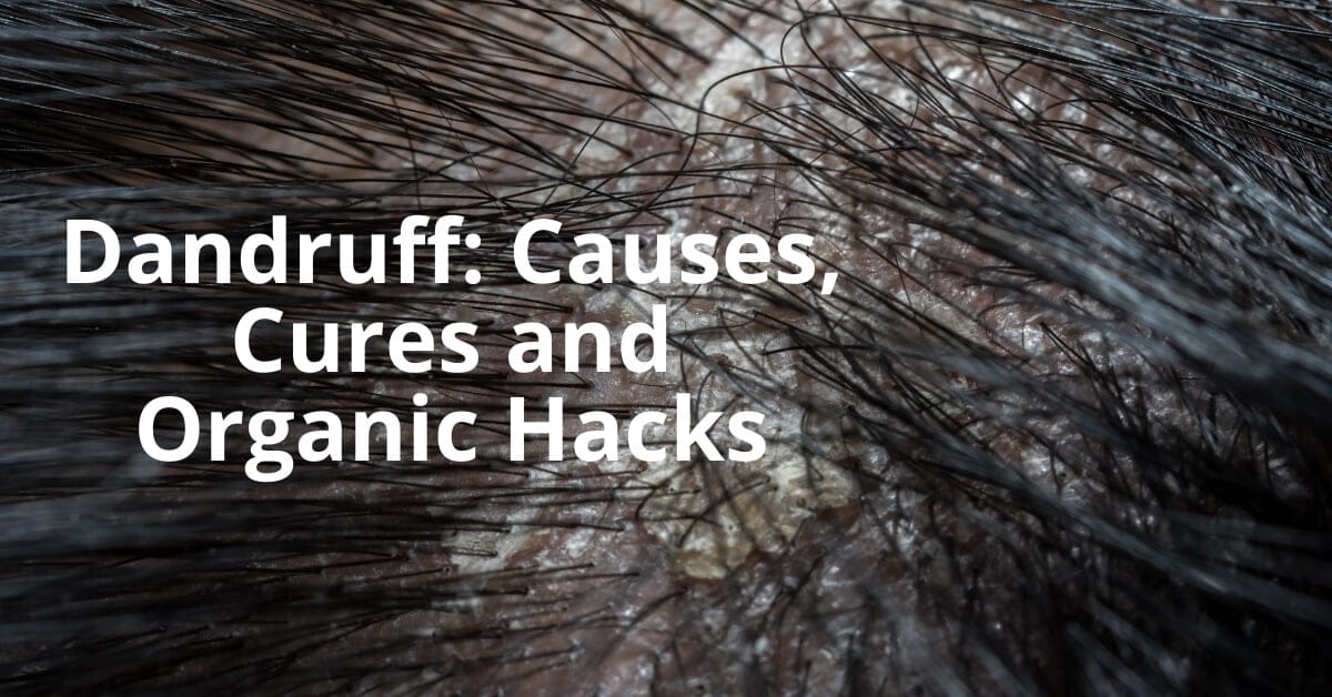 dandruff hacks