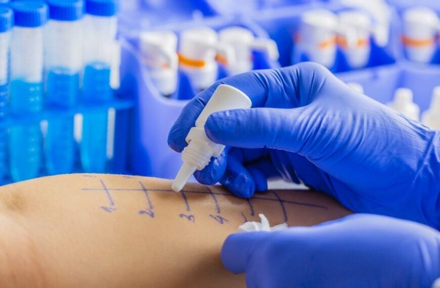 A healthcare professional, possibly the best allergist in Metro Manila, wearing blue gloves places drops of liquid onto marked areas of a patient's forearm for an allergy skin test. In the background, vials of blue liquid are organized in a tray. The patient's forearm is marked with a grid of lines and numbers.