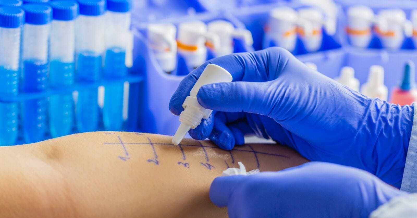 A healthcare professional, possibly the best allergist in Metro Manila, wearing blue gloves places drops of liquid onto marked areas of a patient's forearm for an allergy skin test. In the background, vials of blue liquid are organized in a tray. The patient's forearm is marked with a grid of lines and numbers.