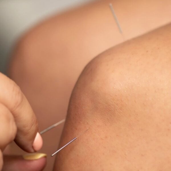 Close-up of an acupuncture session focusing on a person's arm. Thin, metallic needles are inserted into the skin at various points. A practitioner's hand, adorned with a silver ring, is making adjustments to one of the needles with focused precision—an effective therapy practiced widely in Metro Manila.