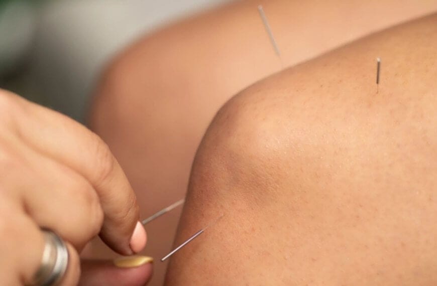 Close-up of an acupuncture session focusing on a person's arm. Thin, metallic needles are inserted into the skin at various points. A practitioner's hand, adorned with a silver ring, is making adjustments to one of the needles with focused precision—an effective therapy practiced widely in Metro Manila.