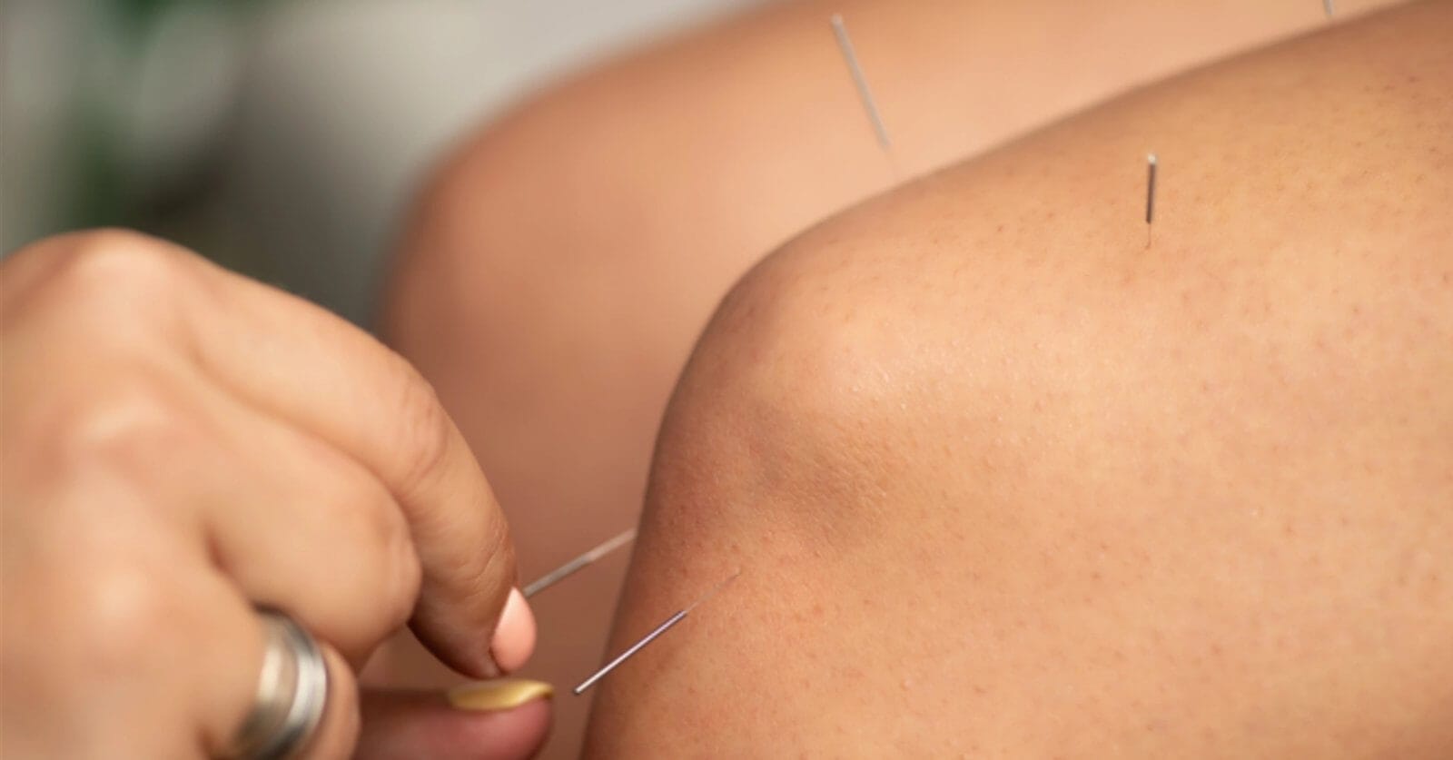 Close-up of an acupuncture session focusing on a person's arm. Thin, metallic needles are inserted into the skin at various points. A practitioner's hand, adorned with a silver ring, is making adjustments to one of the needles with focused precision—an effective therapy practiced widely in Metro Manila.